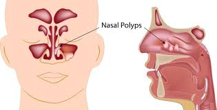 Nose Blockage Treatment in Kolkata