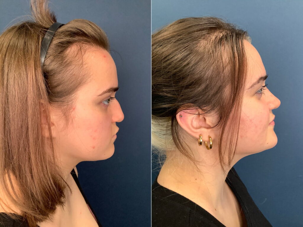 Rhinoplasty in Kolkata