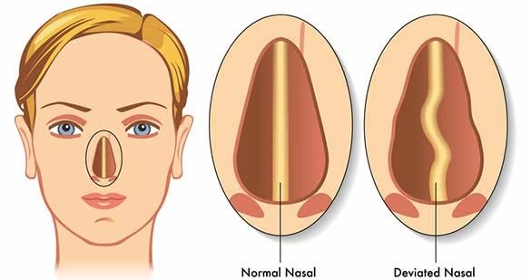 Nose Blockage Treatment in Kolkata