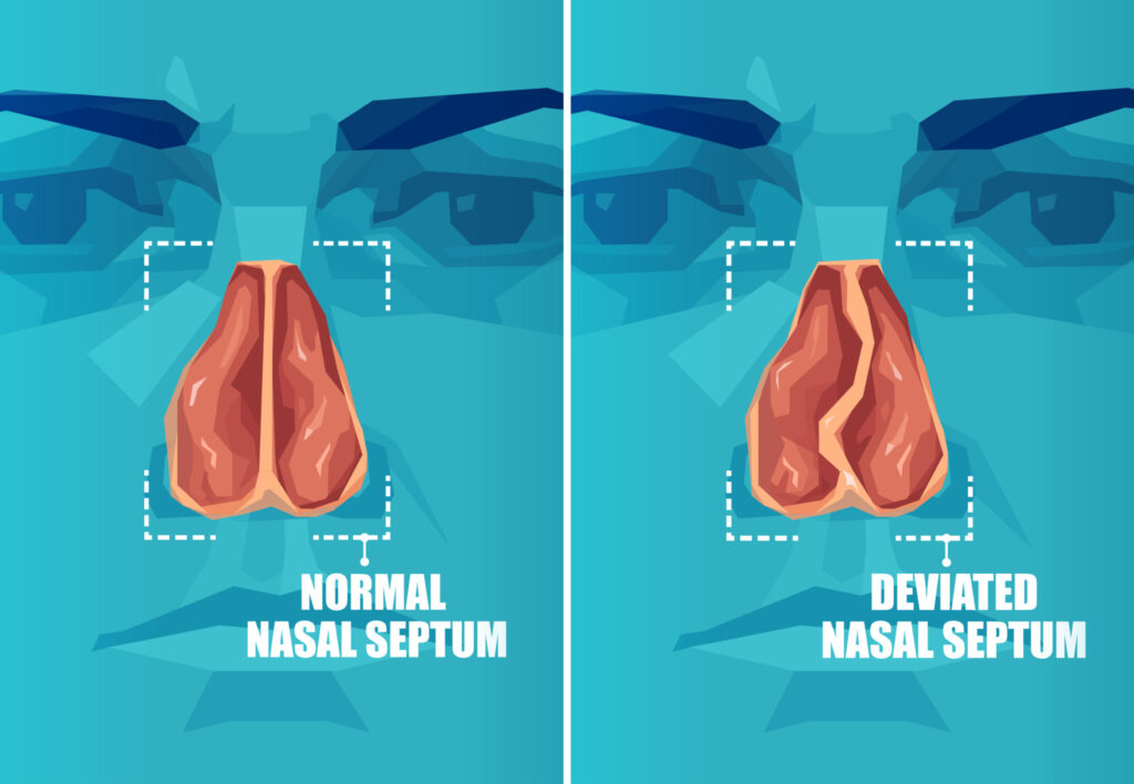 Deviated Septum Treatment in Kolkata