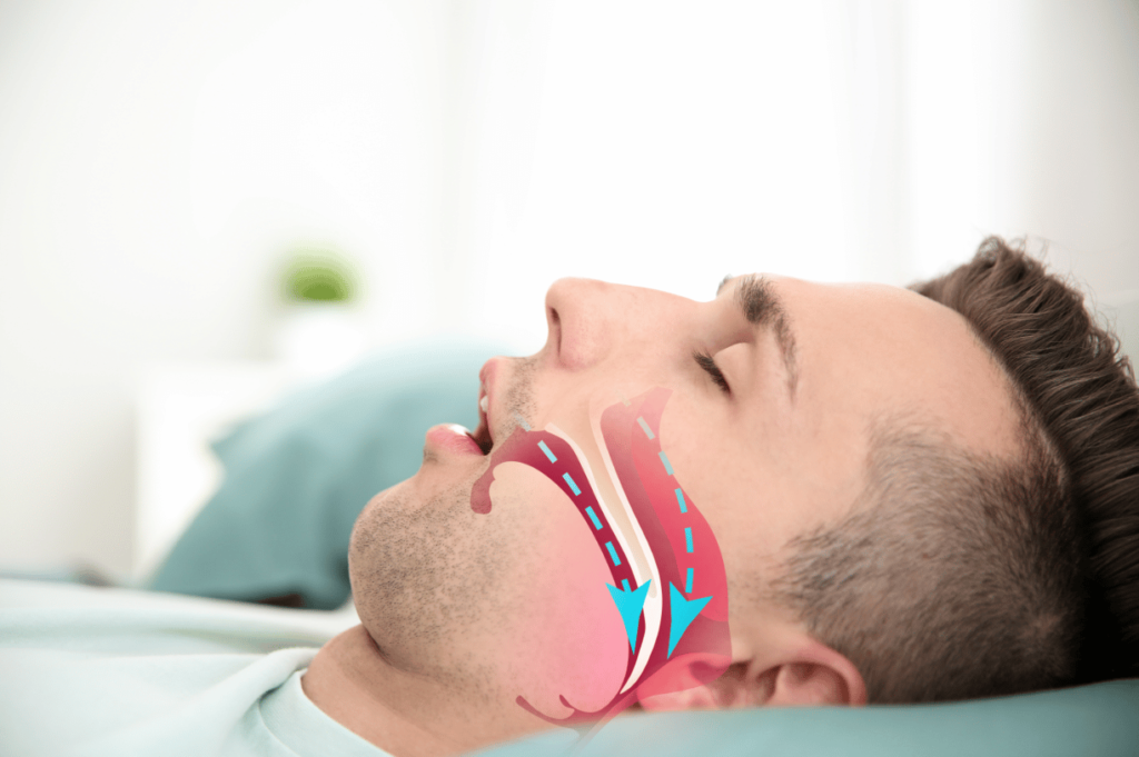 Obstructive sleep apnea in kolkata